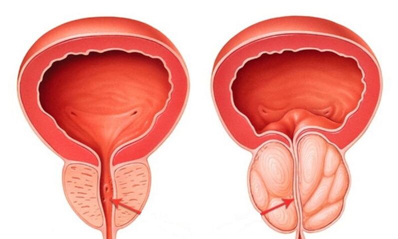 A healthy and inflamed prostate with prostatitis