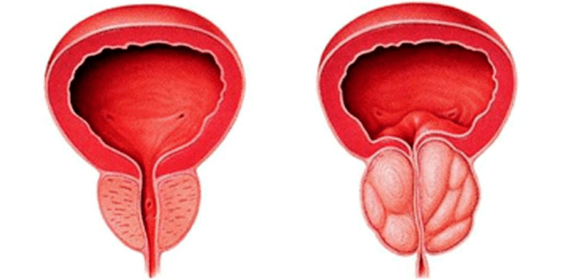 The prostate gland is normal and inflamed